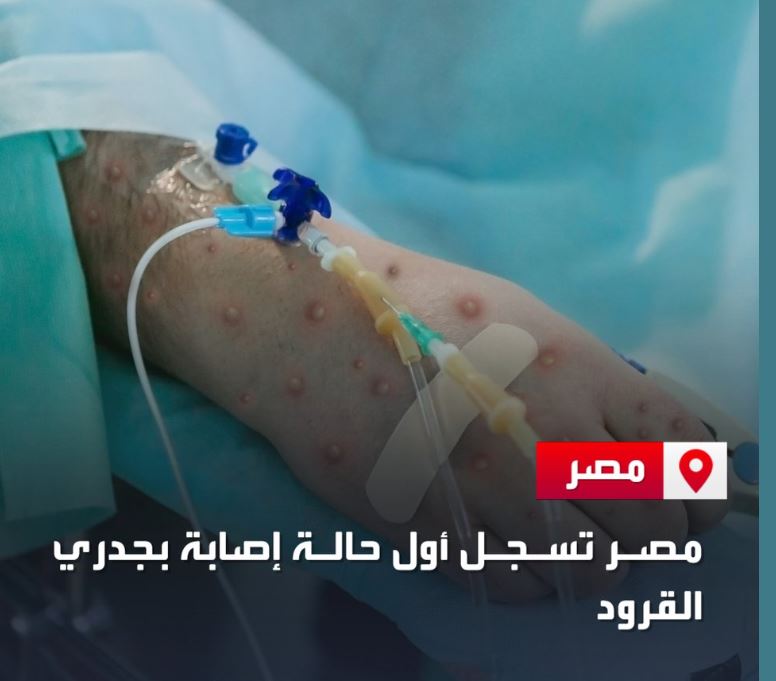 مصر تسجل أول حالة إصابة بجدري القرود